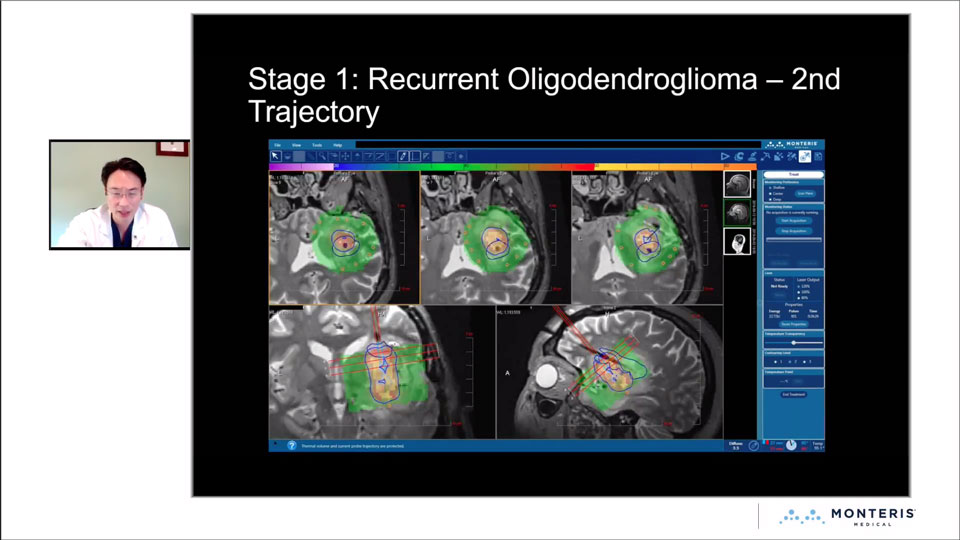 LITT for Glioblastoma and Other Gliomas