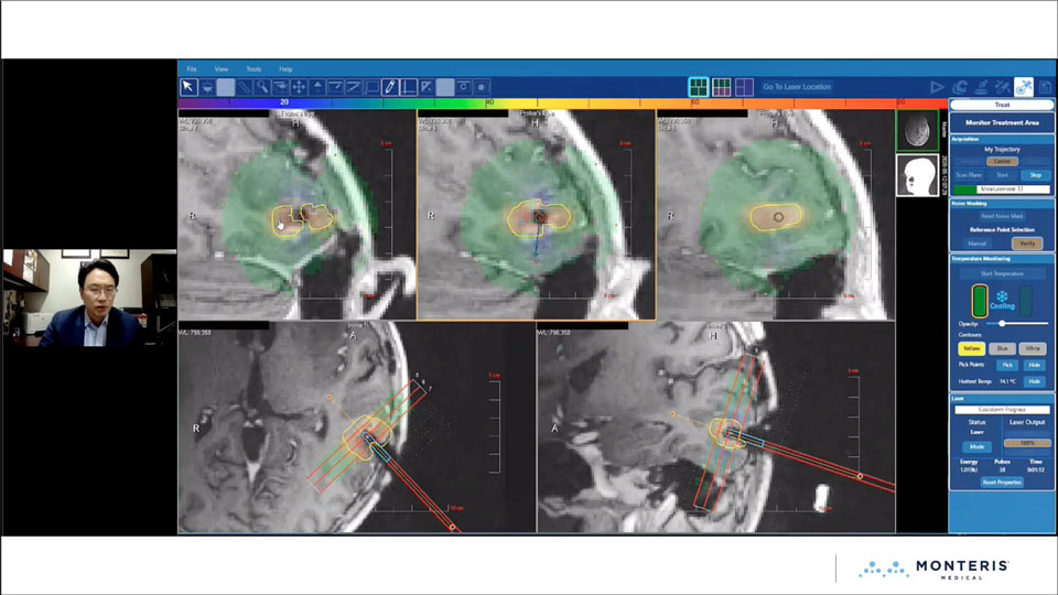 Updates on the Surgical Management of Gliomas and Brain Metastases